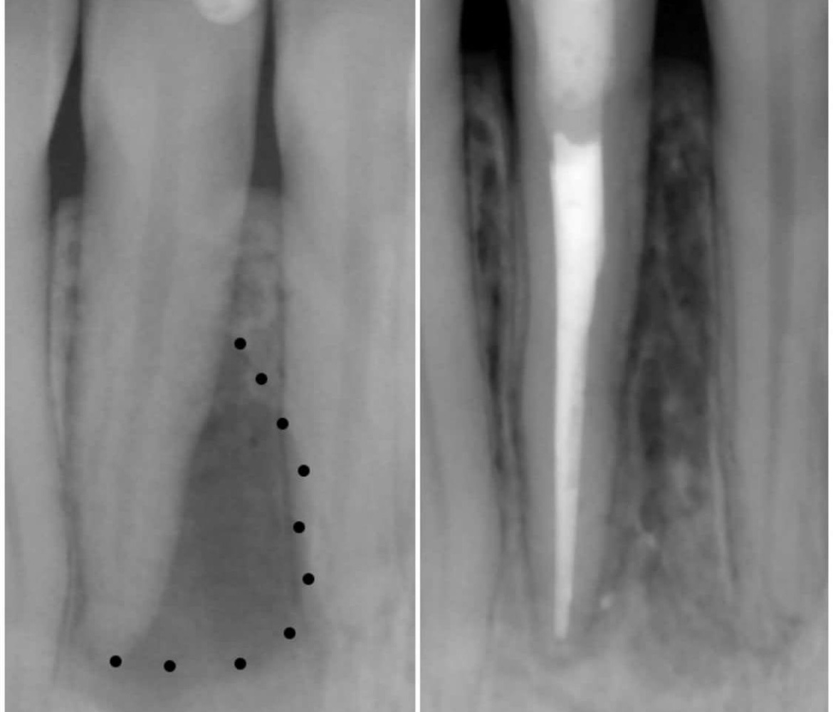 Результат лечения кисты на корне зуба