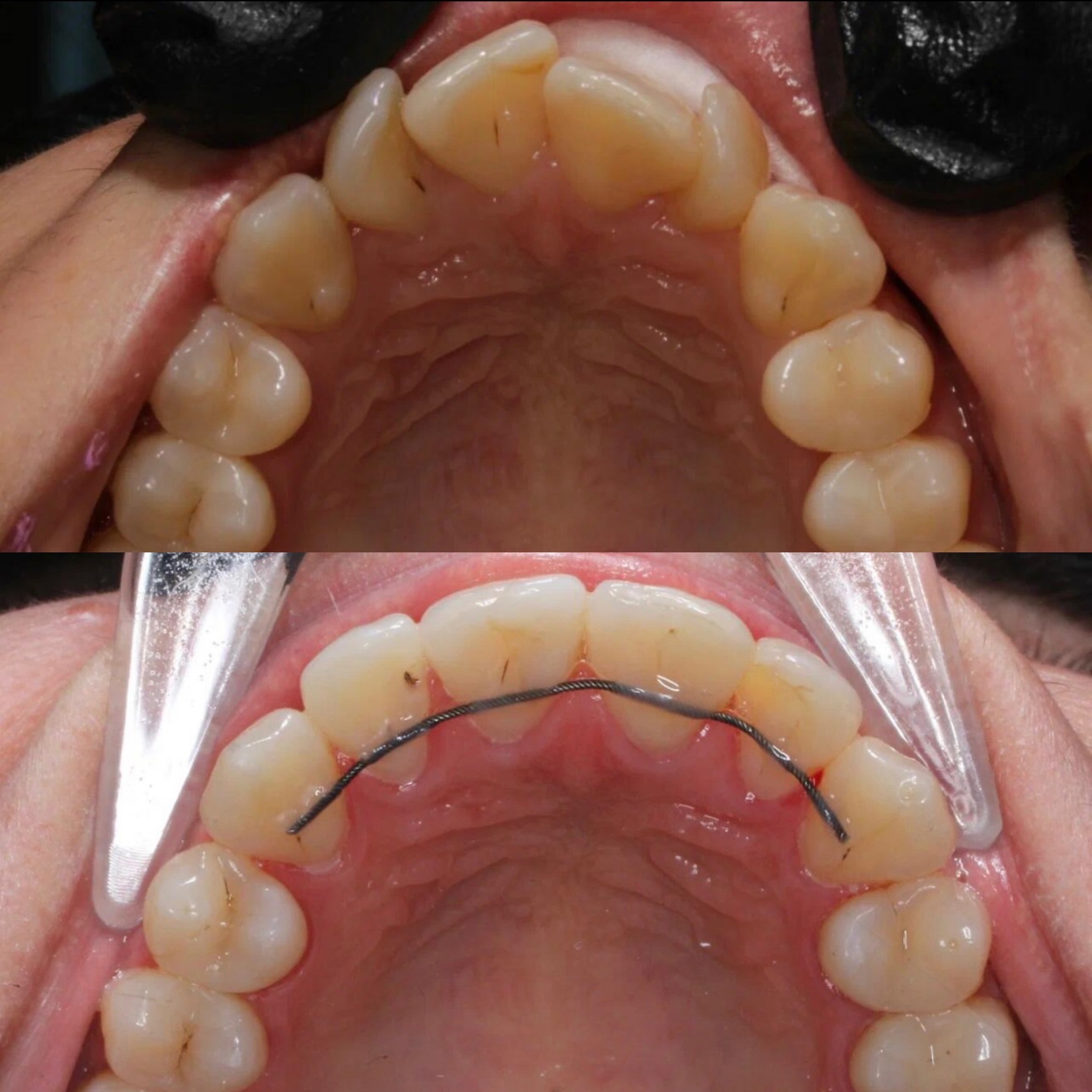 Выравнивание зубов на верхней челюсти