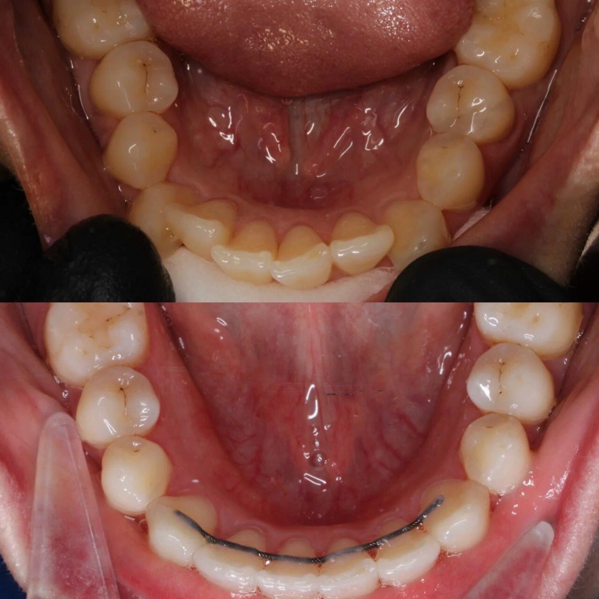 Выравнивание зубов на нижней челюсти
