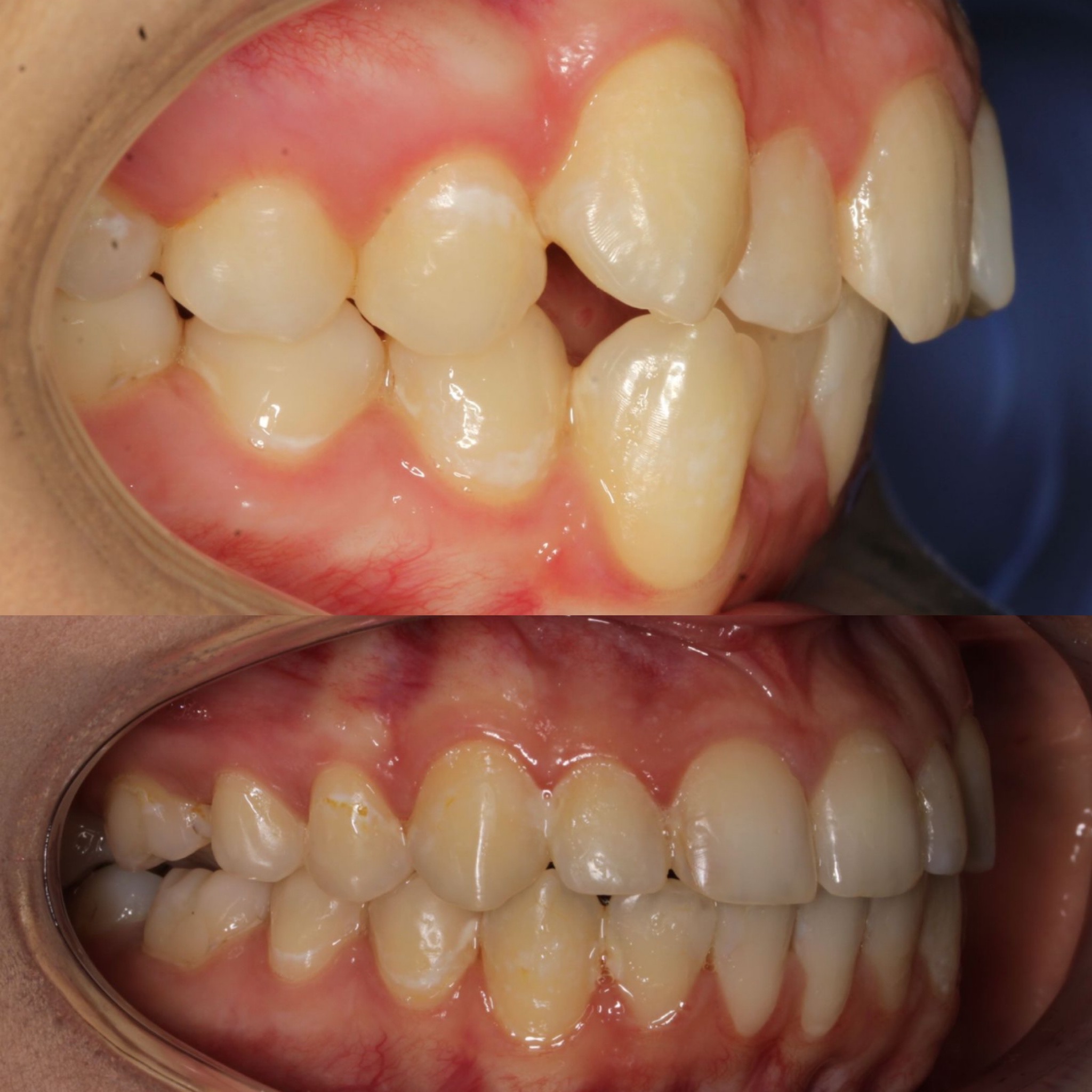 Прикус зубов до брекетов и после лечения