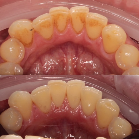 Удаление пигментации на зубах