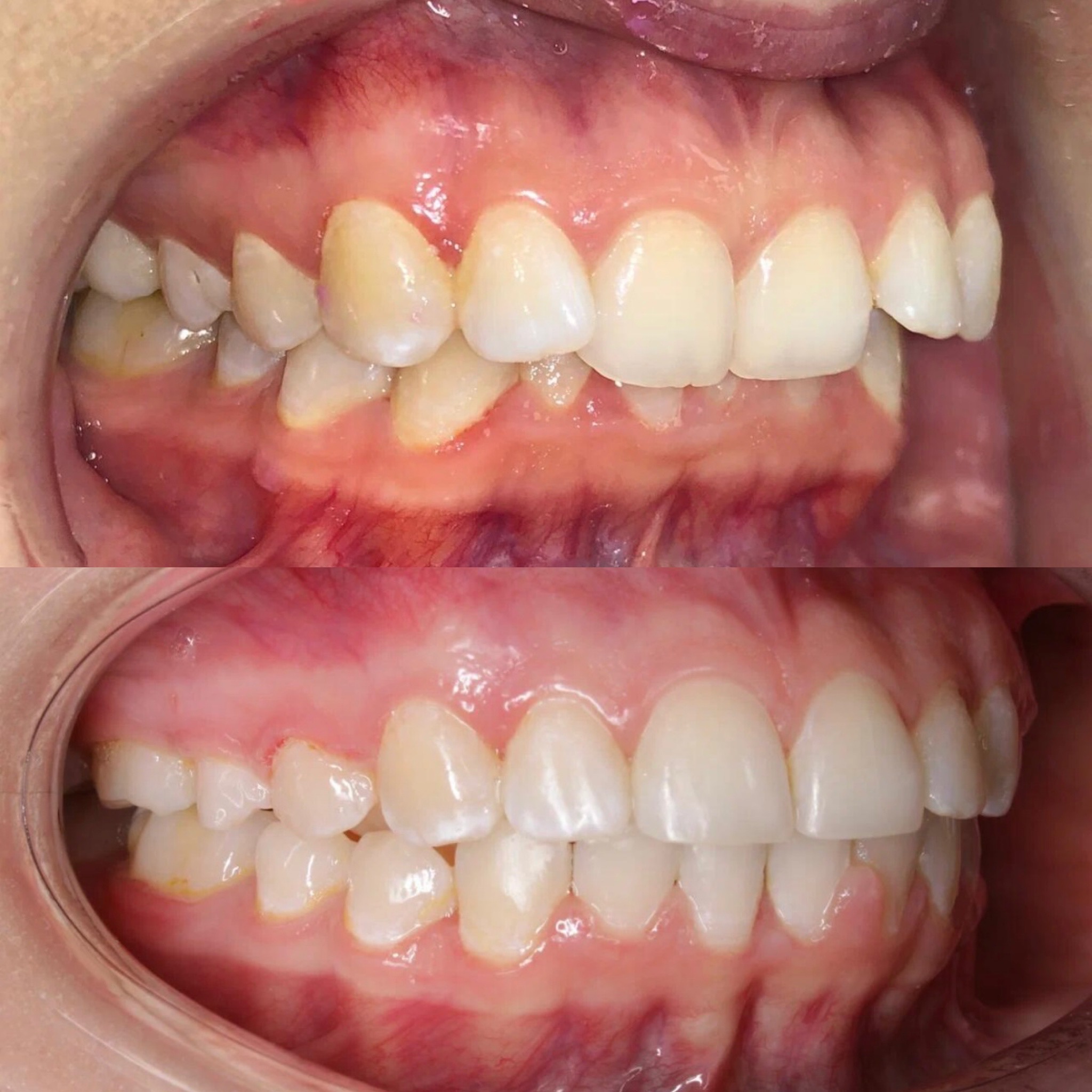 До и после: исправление прикуса зубов
