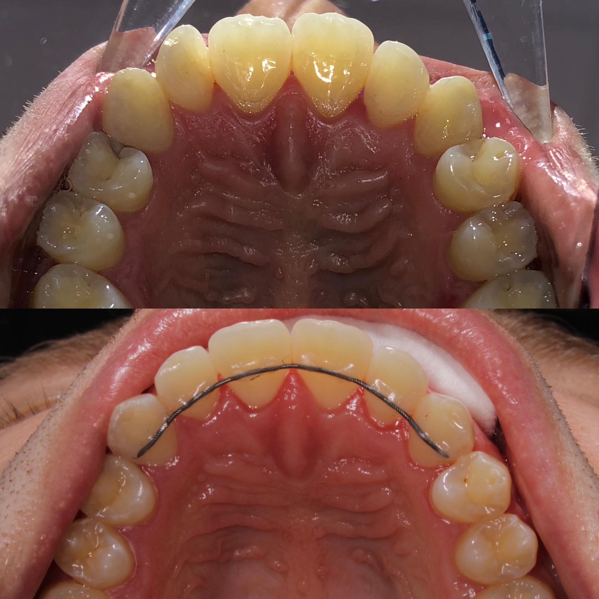 Установка брекетов для исправления верхних зубов