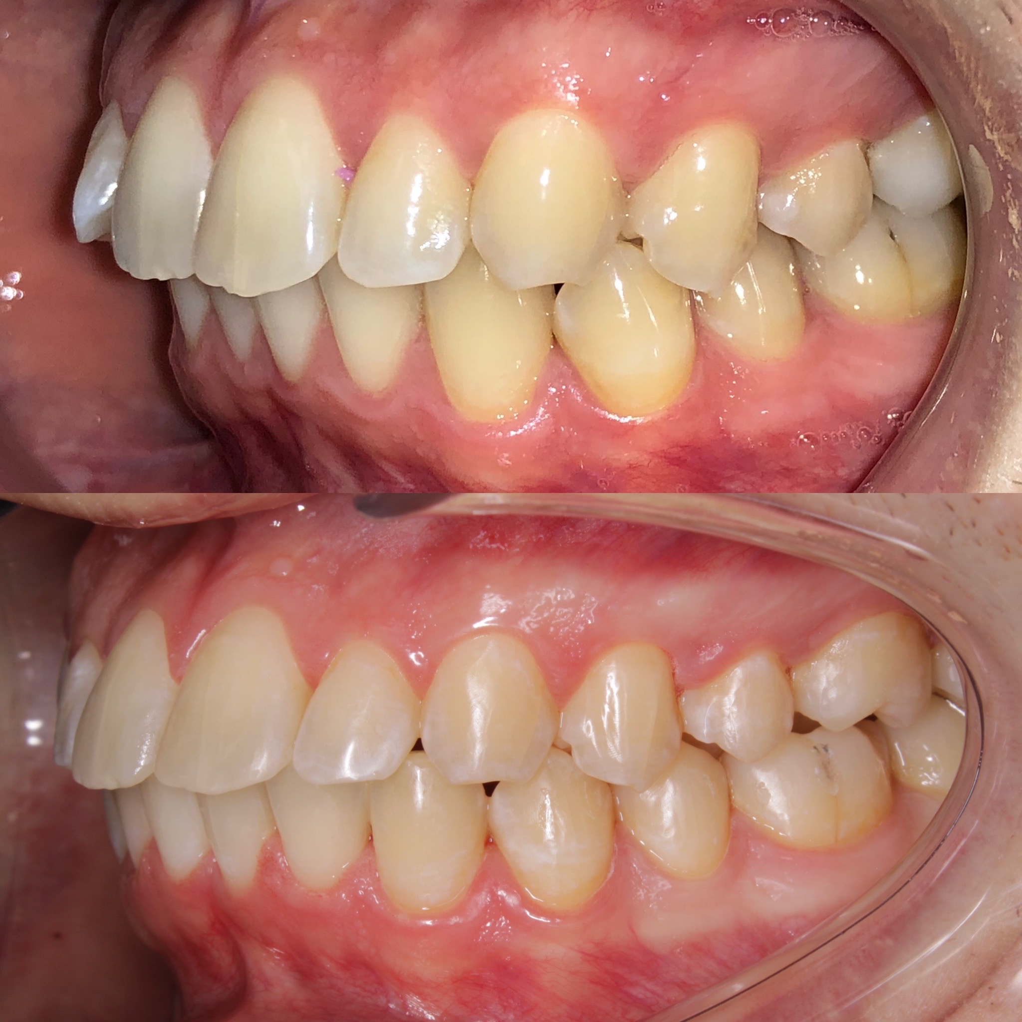 Результат лечения зубов брекетами - 1