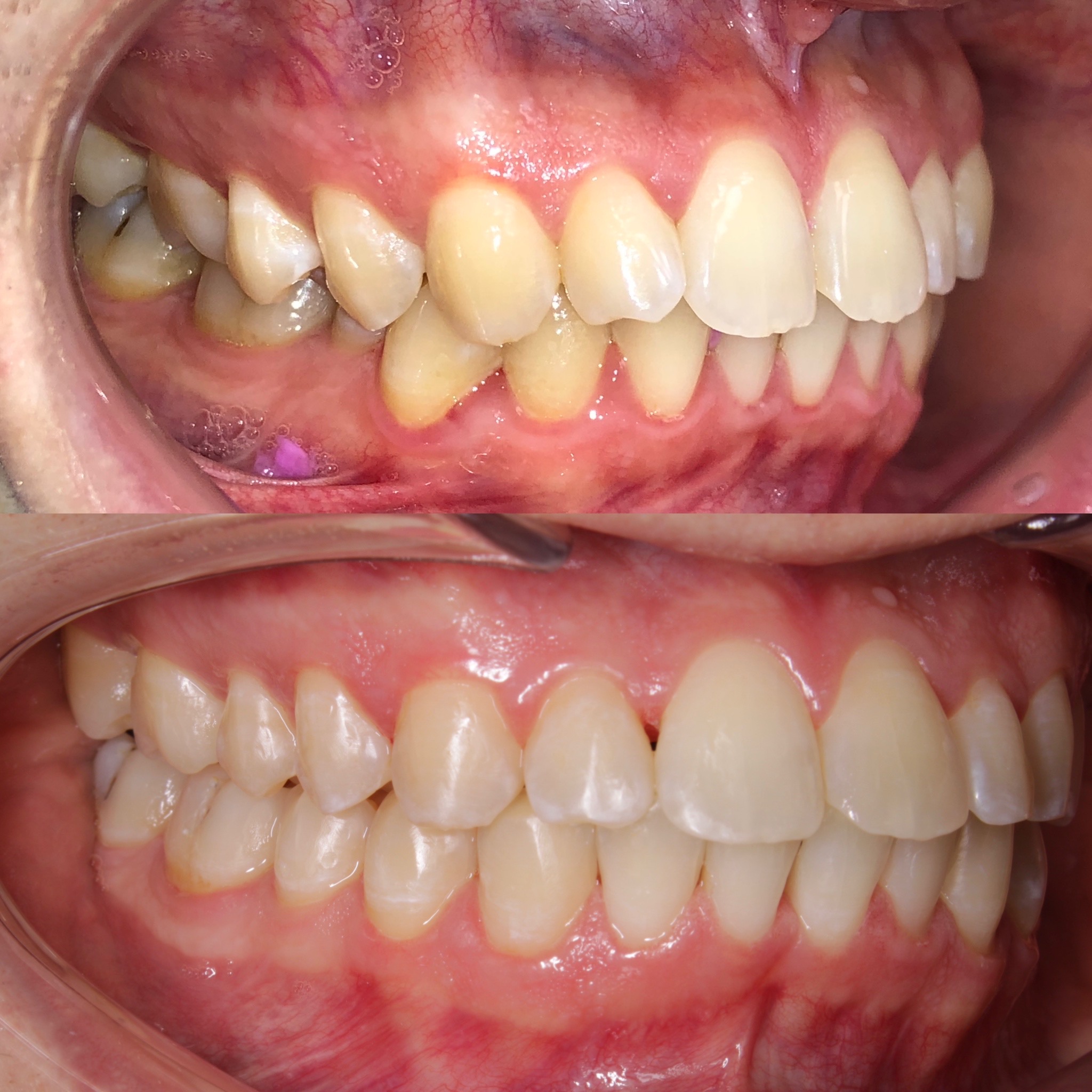Результат лечения зубов брекетами - 2