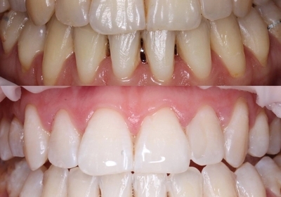 Профессиональная гигиена и отбеливание зубов системой ZOOM