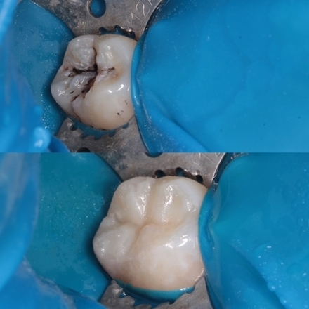 Лечение кариеса на 48 зубе