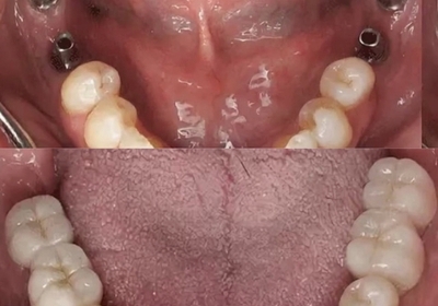 Протезирование жевательных зубов имплантами