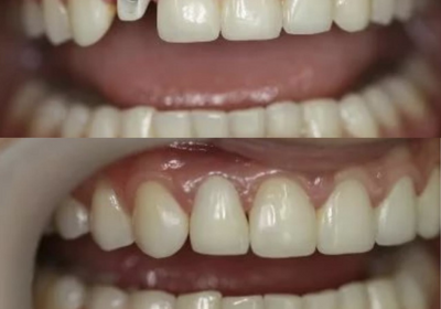 Протезирование переднего зуба при помощи имплантов