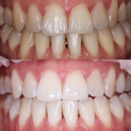 Профессиональная гигиена и отбеливание зубов системой ZOOM