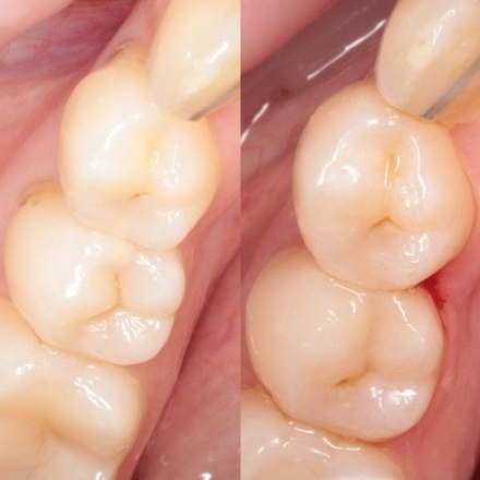 Лечение скрытого кариеса на 3.5 зубе